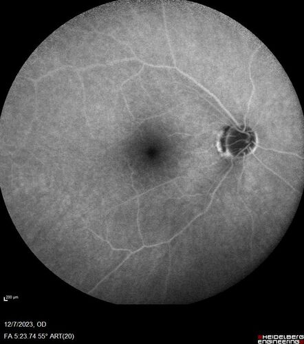 BRVO with good vision
87 year old man with good vision (diabetes without retinopathy).  VA 20/25 OU.  Vision never worsened from BRVO OS.
