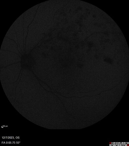 BRVO with good vision
87 year old man with good vision (diabetes without retinopathy).  VA 20/25 OU.  Vision never worsened from BRVO OS.
