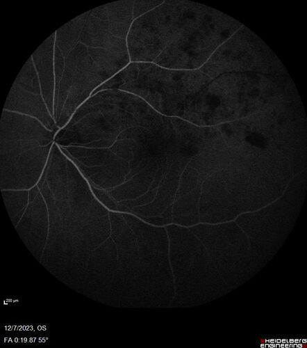 BRVO with good vision
87 year old man with good vision (diabetes without retinopathy).  VA 20/25 OU.  Vision never worsened from BRVO OS.
