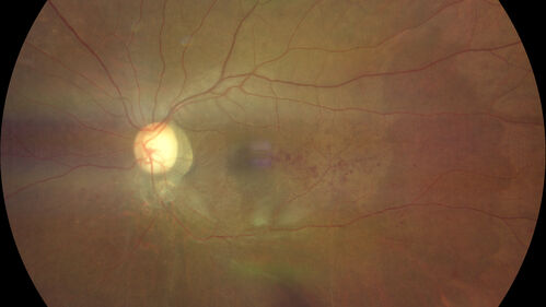 Branch Retinal Vein Occlusion - Foveal Ischemia Neovascularization Non perfusion
38 year  old patient with a BRVO who had PRP laser for vitreous hemorrhage. Vision remained 20/160 from foveal ischemia
