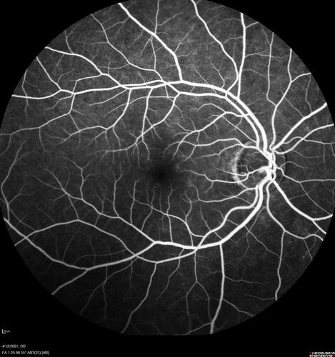 Branch Retinal Vein Occlusion - Foveal Ischemia Neovascularization Non perfusion
38 year  old patient with a BRVO who had PRP laser for vitreous hemorrhage. Vision remained 20/160 from foveal ischemia
