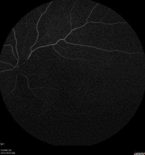 Branch Retinal Vein Occlusion - Foveal Ischemia Neovascularization Non perfusion
38 year  old patient with a BRVO who had PRP laser for vitreous hemorrhage. Vision remained 20/160 from foveal ischemia
