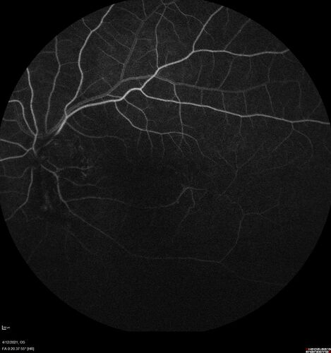 Branch Retinal Vein Occlusion - Foveal Ischemia Neovascularization Non perfusion
38 year  old patient with a BRVO who had PRP laser for vitreous hemorrhage. Vision remained 20/160 from foveal ischemia
