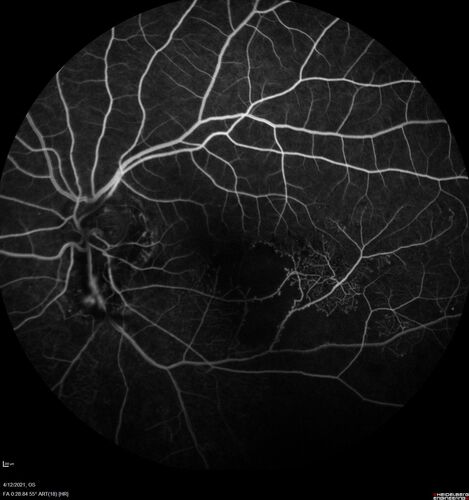 Branch Retinal Vein Occlusion - Foveal Ischemia Neovascularization Non perfusion
38 year  old patient with a BRVO who had PRP laser for vitreous hemorrhage. Vision remained 20/160 from foveal ischemia

