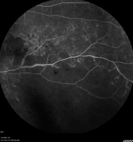 Branch Retinal Vein Occlusion - Foveal Ischemia Neovascularization Non perfusion
38 year  old patient with a BRVO who had PRP laser for vitreous hemorrhage. Vision remained 20/160 from foveal ischemia
