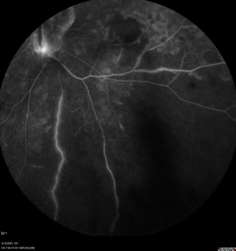 Branch Retinal Vein Occlusion - Foveal Ischemia Neovascularization Non perfusion
38 year  old patient with a BRVO who had PRP laser for vitreous hemorrhage. Vision remained 20/160 from foveal ischemia
