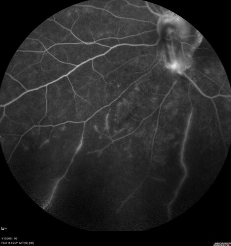 Branch Retinal Vein Occlusion - Foveal Ischemia Neovascularization Non perfusion
38 year  old patient with a BRVO who had PRP laser for vitreous hemorrhage. Vision remained 20/160 from foveal ischemia
