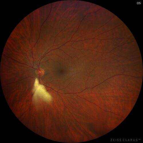 Branch Retinal Vein Occlusion with NVE and vitreous hemorrhage and non-perfusion
50 year old man The right eye was fine and then there was a sudden change in the vision.Â  When he is outside looking at something bright there are thousands of dots with squiggly lines through them.Â 
PMHx: Type II DM (1 year), HTN, AnemiaÂ 
VA OD: sc20/40 PH20/32 NscJ7
VA OS: sc20/160 PH20/25 NscJ2

Myelinate RNFL in the left eye
