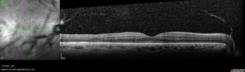 Branch Retinal Vein Occlusion with NVE and vitreous hemorrhage and non-perfusion
50 year old man The right eye was fine and then there was a sudden change in the vision.Â  When he is outside looking at something bright there are thousands of dots with squiggly lines through them.Â 
PMHx: Type II DM (1 year), HTN, AnemiaÂ 
VA OD: sc20/40 PH20/32 NscJ7
VA OS: sc20/160 PH20/25 NscJ2

Myelinate RNFL in the left eye
