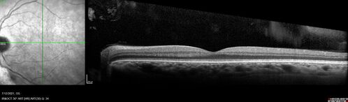 Branch Retinal Vein Occlusion with NVE and vitreous hemorrhage and non-perfusion
50 year old man The right eye was fine and then there was a sudden change in the vision.Â  When he is outside looking at something bright there are thousands of dots with squiggly lines through them.Â 
PMHx: Type II DM (1 year), HTN, AnemiaÂ 
VA OD: sc20/40 PH20/32 NscJ7
VA OS: sc20/160 PH20/25 NscJ2

Myelinate RNFL in the left eye
