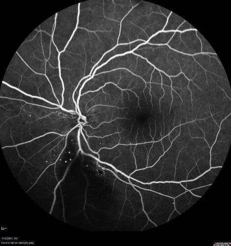 Branch Retinal Vein Occlusion with NVE and vitreous hemorrhage and non-perfusion
50 year old man The right eye was fine and then there was a sudden change in the vision.Â  When he is outside looking at something bright there are thousands of dots with squiggly lines through them.Â 
PMHx: Type II DM (1 year), HTN, AnemiaÂ 
VA OD: sc20/40 PH20/32 NscJ7
VA OS: sc20/160 PH20/25 NscJ2

Myelinate RNFL in the left eye
