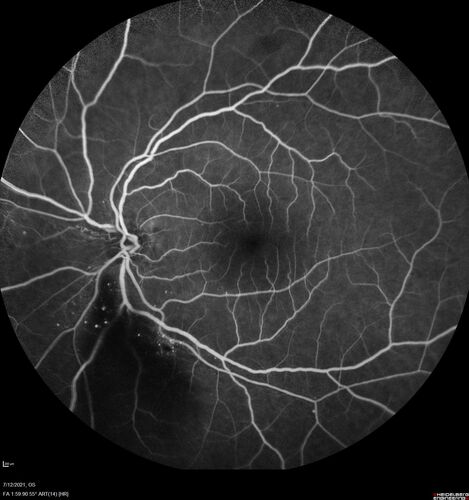 Branch Retinal Vein Occlusion with NVE and vitreous hemorrhage and non-perfusion
50 year old man The right eye was fine and then there was a sudden change in the vision.Â  When he is outside looking at something bright there are thousands of dots with squiggly lines through them.Â 
PMHx: Type II DM (1 year), HTN, AnemiaÂ 
VA OD: sc20/40 PH20/32 NscJ7
VA OS: sc20/160 PH20/25 NscJ2

Myelinate RNFL in the left eye
