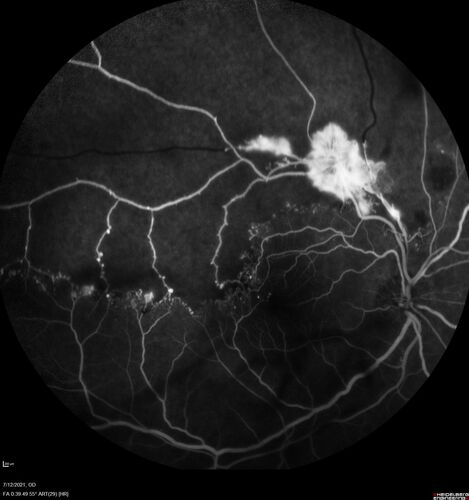Branch Retinal Vein Occlusion with NVE and vitreous hemorrhage and non-perfusion
50 year old man The right eye was fine and then there was a sudden change in the vision.Â  When he is outside looking at something bright there are thousands of dots with squiggly lines through them.Â 
PMHx: Type II DM (1 year), HTN, AnemiaÂ 
VA OD: sc20/40 PH20/32 NscJ7
VA OS: sc20/160 PH20/25 NscJ2

Myelinate RNFL in the left eye
