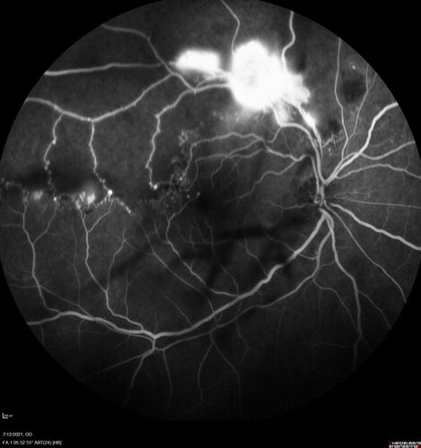 Branch Retinal Vein Occlusion with NVE and vitreous hemorrhage and non-perfusion
50 year old man The right eye was fine and then there was a sudden change in the vision.Â  When he is outside looking at something bright there are thousands of dots with squiggly lines through them.Â 
PMHx: Type II DM (1 year), HTN, AnemiaÂ 
VA OD: sc20/40 PH20/32 NscJ7
VA OS: sc20/160 PH20/25 NscJ2

Myelinate RNFL in the left eye
