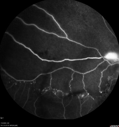 Branch Retinal Vein Occlusion with NVE and vitreous hemorrhage and non-perfusion
50 year old man The right eye was fine and then there was a sudden change in the vision.Â  When he is outside looking at something bright there are thousands of dots with squiggly lines through them.Â 
PMHx: Type II DM (1 year), HTN, AnemiaÂ 
VA OD: sc20/40 PH20/32 NscJ7
VA OS: sc20/160 PH20/25 NscJ2

Myelinate RNFL in the left eye
