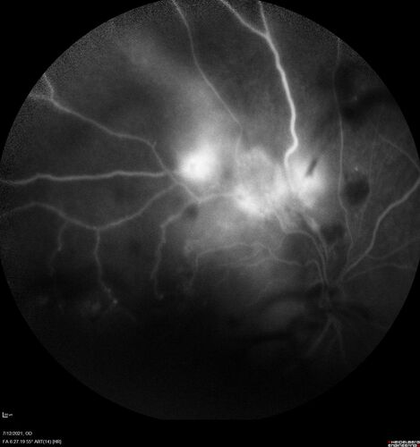 Branch Retinal Vein Occlusion with NVE and vitreous hemorrhage and non-perfusion
50 year old man The right eye was fine and then there was a sudden change in the vision.Â  When he is outside looking at something bright there are thousands of dots with squiggly lines through them.Â 
PMHx: Type II DM (1 year), HTN, AnemiaÂ 
VA OD: sc20/40 PH20/32 NscJ7
VA OS: sc20/160 PH20/25 NscJ2

Myelinate RNFL in the left eye
