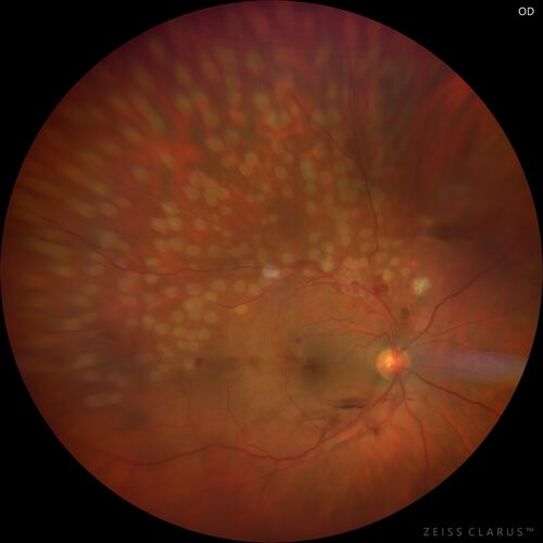 Branch Retinal Vein Occlusion with NVE and vitreous hemorrhage and non-perfusion
50 year old man The right eye was fine and then there was a sudden change in the vision.Â  When he is outside looking at something bright there are thousands of dots with squiggly lines through them.Â 
PMHx: Type II DM (1 year), HTN, AnemiaÂ 
VA OD: sc20/40 PH20/32 NscJ7
VA OS: sc20/160 PH20/25 NscJ2

Myelinate RNFL in the left eye
