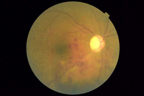 Branch Retinal Vein Occlusion - Both Eyes - Edema OD and NVE OS - Severe Non-perfusion Both Eyes
83 year old man with vision loss for 3 months not sure which eye.  VA 20/100 OD and 20/50 OS.  Tried avastin once without much improvement in the right eye and then lost to follow-up.  FA in the left eye shows leaking NVE

