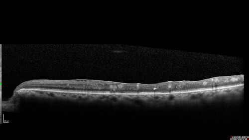 Branch Retinal Vein Occlusion - Both Eyes - Edema OD and NVE OS - Severe Non-perfusion Both Eyes
83 year old man with vision loss for 3 months not sure which eye.  VA 20/100 OD and 20/50 OS.  Tried avastin once without much improvement in the right eye and then lost to follow-up.  FA in the left eye shows leaking NVE
