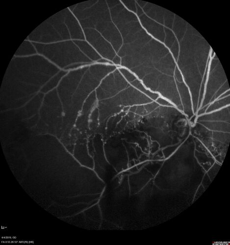Branch Retinal Vein Occlusion - Both Eyes - Edema OD and NVE OS - Severe Non-perfusion Both Eyes
83 year old man with vision loss for 3 months not sure which eye.  VA 20/100 OD and 20/50 OS.  Tried avastin once without much improvement in the right eye and then lost to follow-up.  FA in the left eye shows leaking NVE
