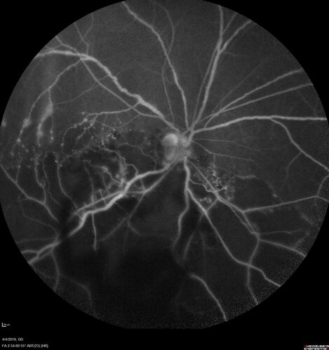 Branch Retinal Vein Occlusion - Both Eyes - Edema OD and NVE OS - Severe Non-perfusion Both Eyes
83 year old man with vision loss for 3 months not sure which eye.  VA 20/100 OD and 20/50 OS.  Tried avastin once without much improvement in the right eye and then lost to follow-up.  FA in the left eye shows leaking NVE
