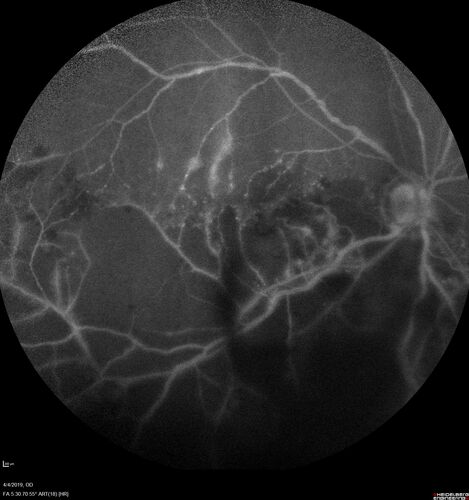 Branch Retinal Vein Occlusion - Both Eyes - Edema OD and NVE OS - Severe Non-perfusion Both Eyes
83 year old man with vision loss for 3 months not sure which eye.  VA 20/100 OD and 20/50 OS.  Tried avastin once without much improvement in the right eye and then lost to follow-up.  FA in the left eye shows leaking NVE
