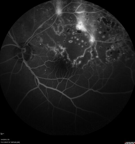 Branch Retinal Vein Occlusion - Both Eyes - Edema OD and NVE OS - Severe Non-perfusion Both Eyes
83 year old man with vision loss for 3 months not sure which eye.  VA 20/100 OD and 20/50 OS.  Tried avastin once without much improvement in the right eye and then lost to follow-up.  FA in the left eye shows leaking NVE
