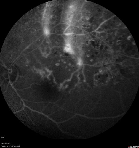 Branch Retinal Vein Occlusion - Both Eyes - Edema OD and NVE OS - Severe Non-perfusion Both Eyes
83 year old man with vision loss for 3 months not sure which eye.  VA 20/100 OD and 20/50 OS.  Tried avastin once without much improvement in the right eye and then lost to follow-up.  FA in the left eye shows leaking NVE
