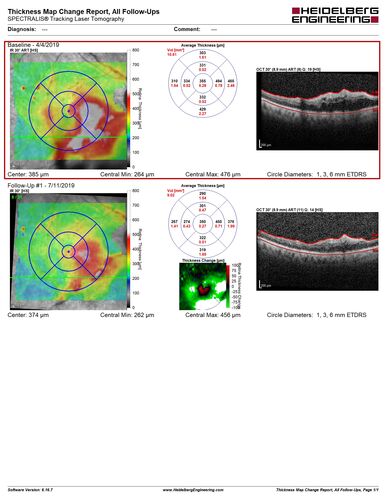Branch Retinal Vein Occlusion - Both Eyes - Edema OD and NVE OS - Severe Non-perfusion Both Eyes
83 year old man with vision loss for 3 months not sure which eye.  VA 20/100 OD and 20/50 OS.  Tried avastin once without much improvement in the right eye and then lost to follow-up.  FA in the left eye shows leaking NVE
