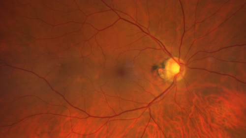 Branch retinal vein occlusion with macular edema
71 year old man Starting about 2 weeks ago the left eye was blurred.  The right eye is seeing well. 
VA OD: sc20/25+2 NccJ1+
VA OS: sc20/63+2 PH20/50-2 Ncc20/400
IOP: TP: OD:19 OS:16
