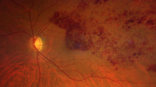 Branch retinal vein occlusion with macular edema
71 year old man Starting about 2 weeks ago the left eye was blurred.  The right eye is seeing well. 
VA OD: sc20/25+2 NccJ1+
VA OS: sc20/63+2 PH20/50-2 Ncc20/400
IOP: TP: OD:19 OS:16
