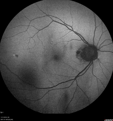 Branch retinal vein occlusion with macular edema
71 year old man Starting about 2 weeks ago the left eye was blurred.  The right eye is seeing well. 
VA OD: sc20/25+2 NccJ1+
VA OS: sc20/63+2 PH20/50-2 Ncc20/400
IOP: TP: OD:19 OS:16
