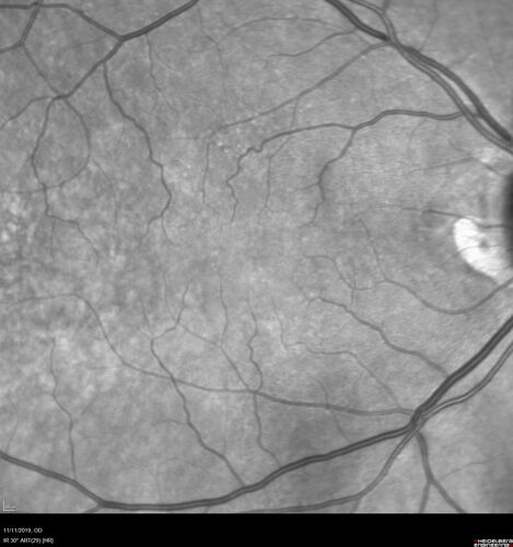 Branch retinal vein occlusion with macular edema
71 year old man Starting about 2 weeks ago the left eye was blurred.  The right eye is seeing well. 
VA OD: sc20/25+2 NccJ1+
VA OS: sc20/63+2 PH20/50-2 Ncc20/400
IOP: TP: OD:19 OS:16
