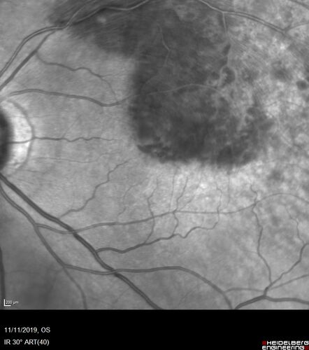 Branch retinal vein occlusion with macular edema
71 year old man Starting about 2 weeks ago the left eye was blurred.  The right eye is seeing well. 
VA OD: sc20/25+2 NccJ1+
VA OS: sc20/63+2 PH20/50-2 Ncc20/400
IOP: TP: OD:19 OS:16
