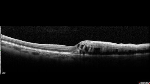 Branch retinal vein occlusion with macular edema
71 year old man Starting about 2 weeks ago the left eye was blurred.  The right eye is seeing well. 
VA OD: sc20/25+2 NccJ1+
VA OS: sc20/63+2 PH20/50-2 Ncc20/400
IOP: TP: OD:19 OS:16
