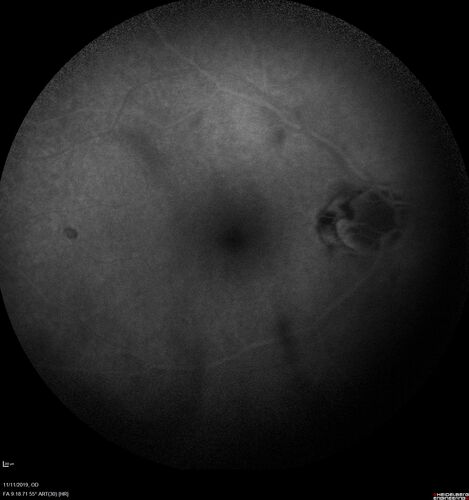 Branch retinal vein occlusion with macular edema
71 year old man Starting about 2 weeks ago the left eye was blurred.  The right eye is seeing well. 
VA OD: sc20/25+2 NccJ1+
VA OS: sc20/63+2 PH20/50-2 Ncc20/400
IOP: TP: OD:19 OS:16
