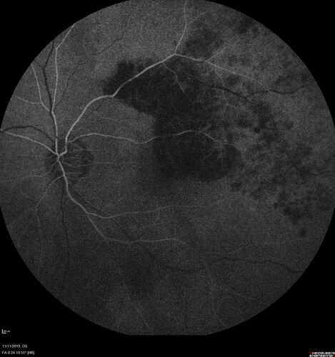 Branch retinal vein occlusion with macular edema
71 year old man Starting about 2 weeks ago the left eye was blurred.  The right eye is seeing well. 
VA OD: sc20/25+2 NccJ1+
VA OS: sc20/63+2 PH20/50-2 Ncc20/400
IOP: TP: OD:19 OS:16
