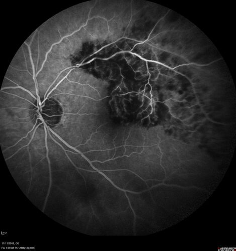 Branch retinal vein occlusion with macular edema
71 year old man Starting about 2 weeks ago the left eye was blurred.  The right eye is seeing well. 
VA OD: sc20/25+2 NccJ1+
VA OS: sc20/63+2 PH20/50-2 Ncc20/400
IOP: TP: OD:19 OS:16

