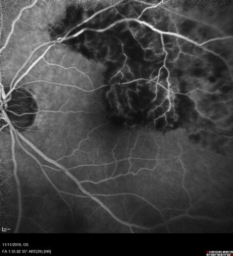 Branch retinal vein occlusion with macular edema
71 year old man Starting about 2 weeks ago the left eye was blurred.  The right eye is seeing well. 
VA OD: sc20/25+2 NccJ1+
VA OS: sc20/63+2 PH20/50-2 Ncc20/400
IOP: TP: OD:19 OS:16
