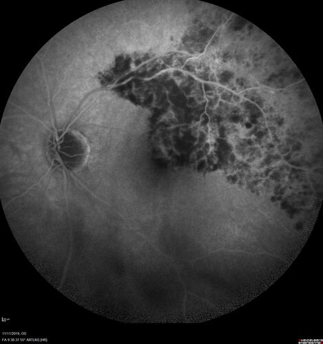 Branch retinal vein occlusion with macular edema
71 year old man Starting about 2 weeks ago the left eye was blurred.  The right eye is seeing well. 
VA OD: sc20/25+2 NccJ1+
VA OS: sc20/63+2 PH20/50-2 Ncc20/400
IOP: TP: OD:19 OS:16
