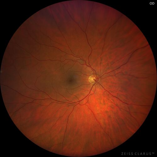 Branch Retinal Vein Occlusion with Neovascularization Elsewhere and Vitreous Hemorrhage
57 year old man New floaters in the left eye about a month ago.  Now they are getting better.  PMHx A-Fib on Pradaxa
VA 20/32 OD, 20/40 OS
1+ NS OU
BP 137/77, 200LBs, 5â€™8â€

PRP laser was done
