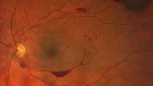 Branch Retinal Vein Occlusion with Neovascularization Elsewhere and Vitreous Hemorrhage
57 year old man New floaters in the left eye about a month ago.  Now they are getting better.  PMHx A-Fib on Pradaxa
VA 20/32 OD, 20/40 OS
1+ NS OU
BP 137/77, 200LBs, 5â€™8â€

PRP laser was done
