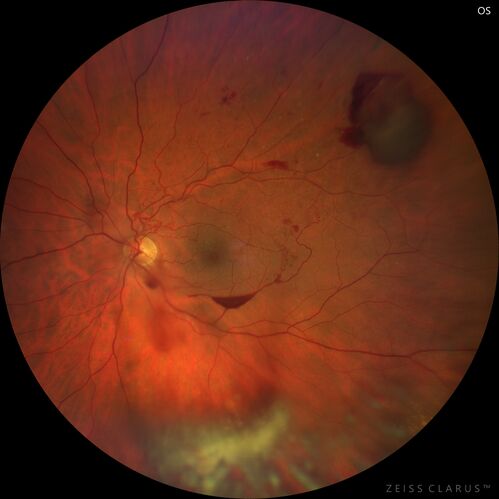 Branch Retinal Vein Occlusion with Neovascularization Elsewhere and Vitreous Hemorrhage
57 year old man New floaters in the left eye about a month ago.  Now they are getting better.  PMHx A-Fib on Pradaxa
VA 20/32 OD, 20/40 OS
1+ NS OU
BP 137/77, 200LBs, 5â€™8â€

PRP laser was done
