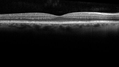 Branch Retinal Vein Occlusion with Neovascularization Elsewhere and Vitreous Hemorrhage
57 year old man New floaters in the left eye about a month ago.  Now they are getting better.  PMHx A-Fib on Pradaxa
VA 20/32 OD, 20/40 OS
1+ NS OU
BP 137/77, 200LBs, 5â€™8â€

PRP laser was done
