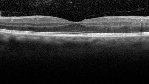 Branch Retinal Vein Occlusion with Neovascularization Elsewhere and Vitreous Hemorrhage
57 year old man New floaters in the left eye about a month ago.  Now they are getting better.  PMHx A-Fib on Pradaxa
VA 20/32 OD, 20/40 OS
1+ NS OU
BP 137/77, 200LBs, 5â€™8â€

PRP laser was done
