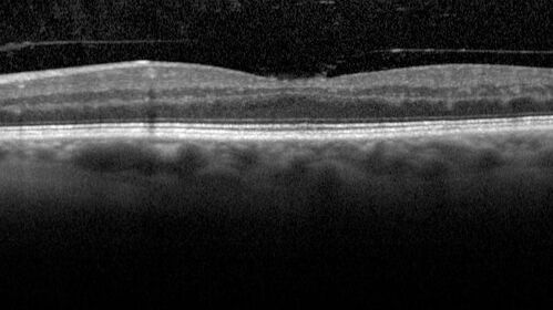 Branch Retinal Vein Occlusion with Neovascularization Elsewhere and Vitreous Hemorrhage
57 year old man New floaters in the left eye about a month ago.  Now they are getting better.  PMHx A-Fib on Pradaxa
VA 20/32 OD, 20/40 OS
1+ NS OU
BP 137/77, 200LBs, 5â€™8â€

PRP laser was done
