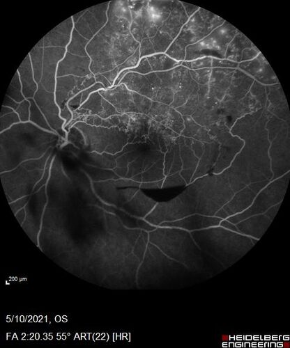 Branch Retinal Vein Occlusion with Neovascularization Elsewhere and Vitreous Hemorrhage
57 year old man New floaters in the left eye about a month ago.  Now they are getting better.  PMHx A-Fib on Pradaxa
VA 20/32 OD, 20/40 OS
1+ NS OU
BP 137/77, 200LBs, 5â€™8â€

PRP laser was done
