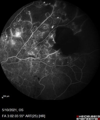 Branch Retinal Vein Occlusion with Neovascularization Elsewhere and Vitreous Hemorrhage
57 year old man New floaters in the left eye about a month ago.  Now they are getting better.  PMHx A-Fib on Pradaxa
VA 20/32 OD, 20/40 OS
1+ NS OU
BP 137/77, 200LBs, 5â€™8â€

PRP laser was done
