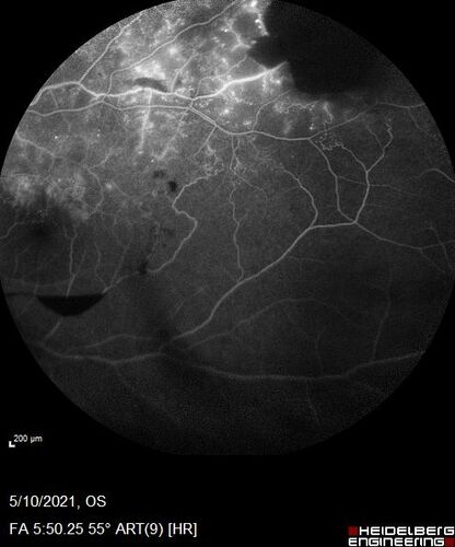 Branch Retinal Vein Occlusion with Neovascularization Elsewhere and Vitreous Hemorrhage
57 year old man New floaters in the left eye about a month ago.  Now they are getting better.  PMHx A-Fib on Pradaxa
VA 20/32 OD, 20/40 OS
1+ NS OU
BP 137/77, 200LBs, 5â€™8â€

PRP laser was done
