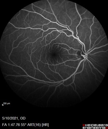 Branch Retinal Vein Occlusion with Neovascularization Elsewhere and Vitreous Hemorrhage
57 year old man New floaters in the left eye about a month ago.  Now they are getting better.  PMHx A-Fib on Pradaxa
VA 20/32 OD, 20/40 OS
1+ NS OU
BP 137/77, 200LBs, 5â€™8â€

PRP laser was done
